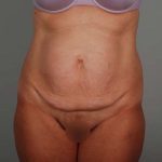 Abdominoplasty Before & After Patient #1330