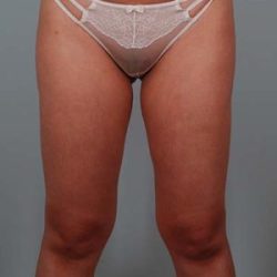 Liposuction Before & After Patient #1645