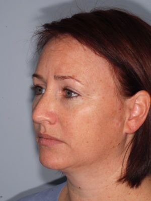 Laser Skin Resurfacing Before & After Patient #2200