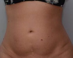 Emsculpt Neo Before & After Patient #2174