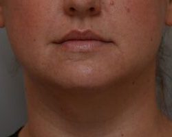 Neck Liposuction Before & After Patient #2008