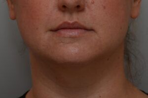 Neck Liposuction Before & After Patient #2008