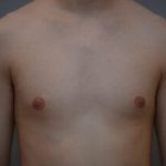 Gynecomastia Before & After Patient #1160