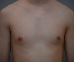 Gynecomastia Before & After Patient #1160