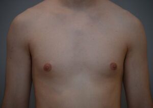 Gynecomastia Before & After Patient #1160