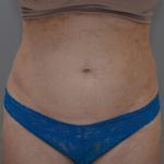 Liposuction with Bodytite Before & After Patient #1558