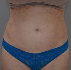 Liposuction with Bodytite Before & After Patient #1558