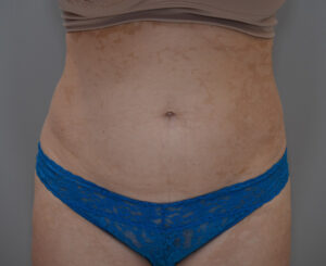 Liposuction with Bodytite Before & After Patient #1558