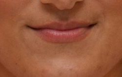 Lip Filler Before & After Patient #2246