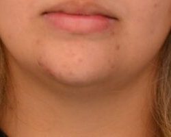 Neck Liposuction Before & After Patient #2007