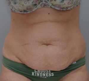 Abdominoplasty Before & After Patient #1496