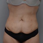 Abdominoplasty Before & After Patient #1495