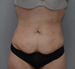 Abdominoplasty Before & After Patient #1495