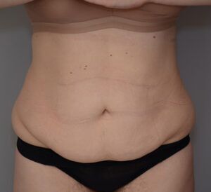 Abdominoplasty Before & After Patient #1494