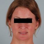 Facelift Before & After Patient #1743