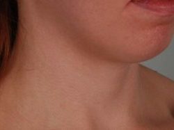 Neck Liposuction Before & After Patient #2005