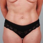 Abdominoplasty Before & After Patient #1326