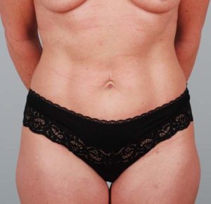 Abdominoplasty Before & After Patient #1326