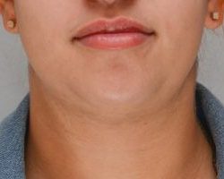 Neck Liposuction Before & After Patient #2006