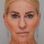 Facelift Before & After Patient #1745
