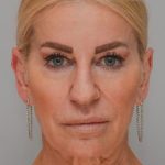 Face And Neck Lift Before & After Patient #1745