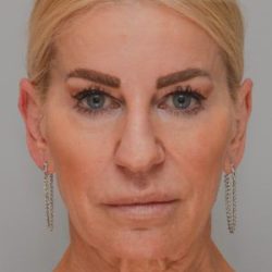 Facelift Before & After Patient #1745