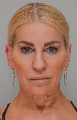 Facelift Before & After Patient #1745