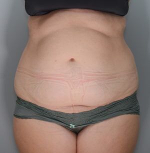 Abdominoplasty Before & After Patient #1271