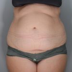 Liposuction Before & After Patient #1643