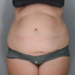 Abdominoplasty Before & After Patient #1643