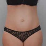 Abdominoplasty Before & After Patient #1387