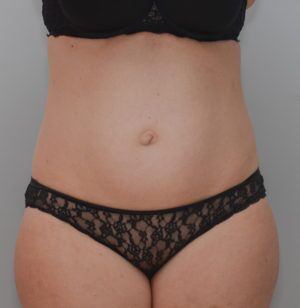 Abdominoplasty Before & After Patient #1387