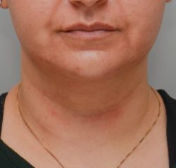 Facetite Before & After Patient #1883