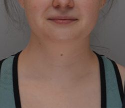 Neck Liposuction Before & After Patient #1952