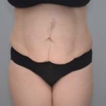 Abdominoplasty Before & After Patient #1210