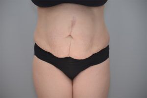 Abdominoplasty Before & After Patient #1210