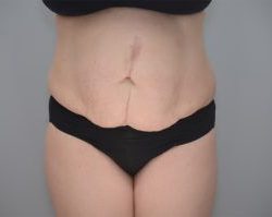 Abdominoplasty Before & After Patient #1589