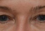 Blepharoplasty Before & After Patient #1703