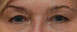 Blepharoplasty Before & After Patient #1703