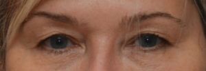 Blepharoplasty Before & After Patient #1703