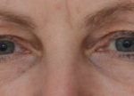 Blepharoplasty Before & After Patient #1704