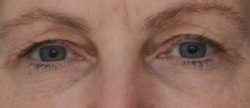 Blepharoplasty Before & After Patient #1704