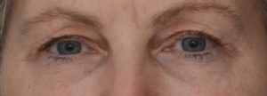 Blepharoplasty Before & After Patient #1704