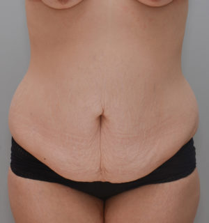 Abdominoplasty Before & After Patient #1440