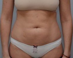 Emsculpt Neo Before & After Patient #2172