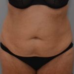 Abdominoplasty Before & After Patient #1443