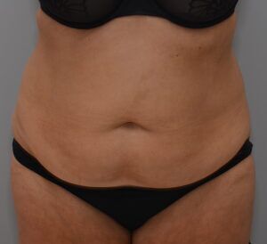 Abdominoplasty Before & After Patient #1443