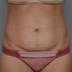 Abdominoplasty Before & After Patient #1442