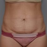 Abdominoplasty Before & After Patient #1442