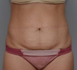 Abdominoplasty Before & After Patient #1442